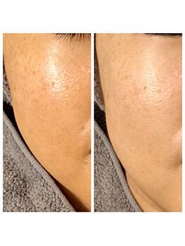 エリン(ERIN)/セラピール