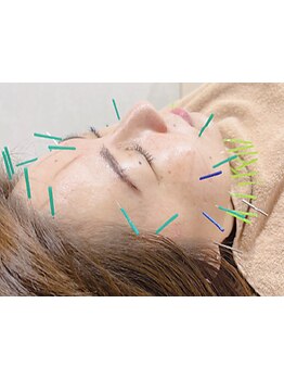 鍼灸施術を受けたい