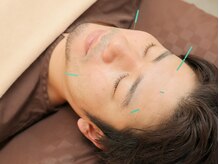 川口そうぜん鍼灸院/男性の美容鍼も人気