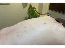 鍼灸ハウス(鍼灸house)/