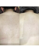 ビューティーサロン シャーロット(Beauty Salon Charlotte)/お背中ケア/お背中ハーブ