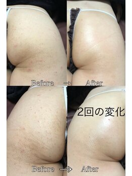 ココティー 大阪店(Cocotii)/おしり 2回のケアの変化です