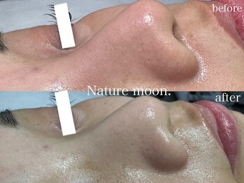 ナチュールムーン(Nature moon.)/毛穴洗浄