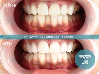 セルフホワイトニング専門店 シマエナ上新庄駅前店/初めての方も1回で実感