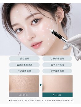 ユアンスボーテ(Yuence Beaute)の写真/毛穴が減る!オーナーも感動!韓国の進化した植えるエクソソームで3日間かけて毛穴が減少して水光肌に♪