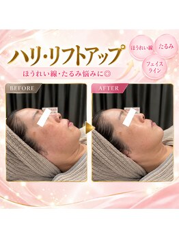 Lana.【毛穴/シミ/たるみ/肌質改善】の写真/気になるほうれい線・たるみ・フェイスラインを徹底ケア!ラジオ波×EMSで、ふっくらハリ肌へ。