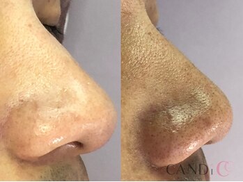 キャンディ 大阪梅田店(CANDi)/ハイドラピーリング/黒ずみ毛穴