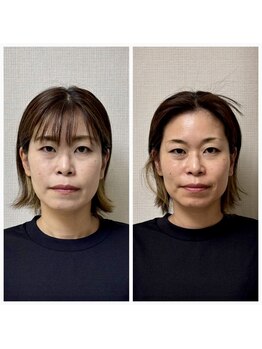 ドクターコガオ 福山店(Dr.小顔)/☆施術1回での変化☆