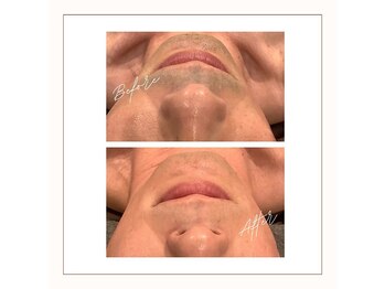 ラベニール(La Benir)/ひげ脱毛