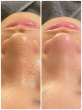 ルカシエ(Le Cacie)/30代女性/毛穴洗浄