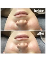 アウラ(AURA)/ダクトピール　before/after