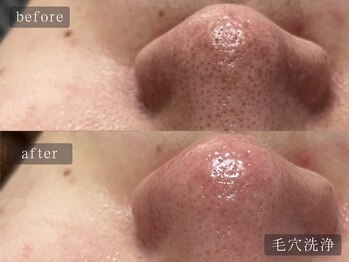 アムールサロン(Amour salon)/ハイドラ/毛穴洗浄/四谷三丁目