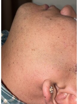 ベルフィオーレ(bel fiore)/20代男性 初回