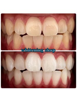 ホワイトニングショップ 武蔵小杉店/【BeforeAfter】4回 施術後比較