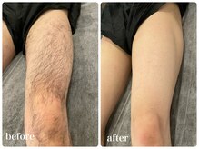 エリクサー 加須店(Elixir)/太ももの毛も脱毛しましょ