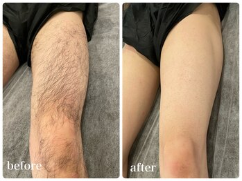 エリクサー 加須店(Elixir)/太ももの毛も脱毛しましょ