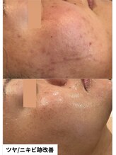 ミラビューティー(Mira Beauty)/ニキビ改善/ツヤ肌