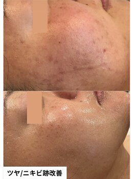 ミラビューティー(Mira Beauty)/ニキビ改善/ツヤ肌