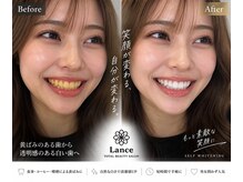 ランス 天神今泉店(Lance)/【どちらの方が印象いいですか】