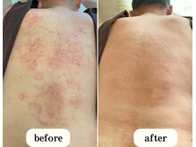 恵比寿ループ鍼灸院(LOOP)/乾癬などの難しい症状も◯