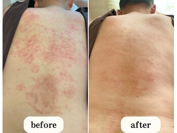 恵比寿ループ鍼灸院(LOOP)/乾癬などの難しい症状も◯