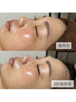 デジール(desir)/【フェイシャル】 before/after