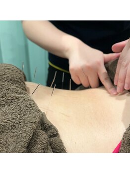 足のトラブルセンター 新札幌店/深部の凝りには鍼がおすすめ