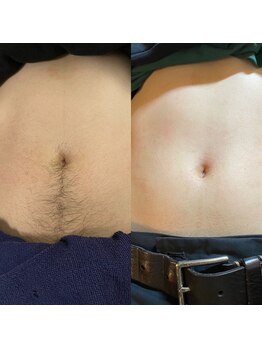 メンズガーデン 今池店/メンズ全身脱毛腹脱毛