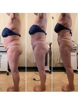 美肌工房ルノン(Lunon)/ダイエット：before／after