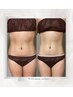 お悩み産後ダイエット集中痩身コース★妊娠線も薄く無る？！