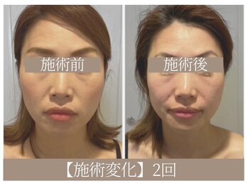 ドクターボディ 恵比寿店(Dr.Body)/【顔の歪み/エラの張り 30代】