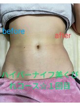 サロンドリドミ 新瑞橋店(Salon de ridomi)/ハイパーナイボディお腹