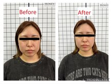 もものき/小顔矯正