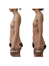 ベンザイ 梅田店(BENZAI)/肋骨開き、反り腰、下垂