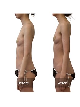 ベンザイ 梅田店(BENZAI)/肋骨開き、反り腰、下垂