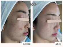 りりあすの雰囲気(しつこかった肌荒れも正しいスキンケアとサロントリートメントで)