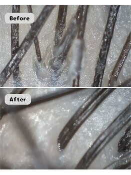 ストリクス(STRIX)/ベタつき頭皮改善/Before＆After