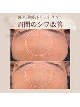 フェイスネイル(face＆nail)/ハーブピーリング