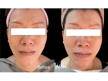 ティパニボーテ(Tipani Beaute')/リッチリフト