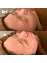 ルナージュ 三田店(LUNARLE)/剥けないハーブピーリング