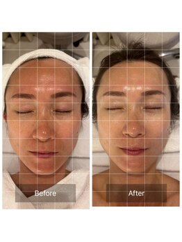 マインエム(mine.m)/頭蓋骨小顔矯正