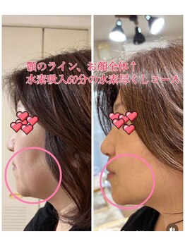 ヨサパーク アミカル 八幡山店(YOSAPARK amical)/お顔のたるみも水素で改善！