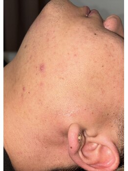 ベルフィオーレ(bel fiore)/20代男性 4回目