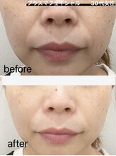 イル 名取店(iru)/プラズマフェイシャル