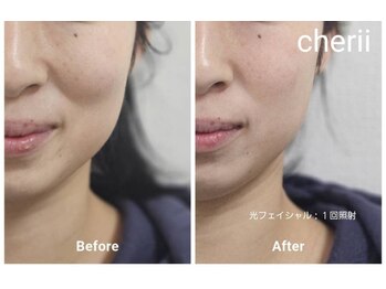 シェリ(Cherii)の写真/ほうれい線＆エラの張りをなくしたい！フェイスラインをきれいに。光フェイシャルでスッキリ小顔に変化♪