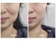 シェリ(Cherii)の写真/ほうれい線＆エラの張りをなくしたい！フェイスラインをきれいに。光フェイシャルでスッキリ小顔に変化♪