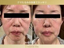 トゥジュール イエリック(Toujours ierik)/くま・たるみエイジングケア