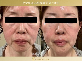 トゥジュール イエリック(Toujours ierik)/くま・たるみエイジングケア