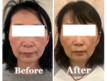 サロンベイビー 尼崎塚口店(Salon Baby)/【小顔美容整顔】Before・After