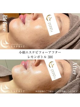 エスプリ 銀座店/レモンボトルで顔がシュッと